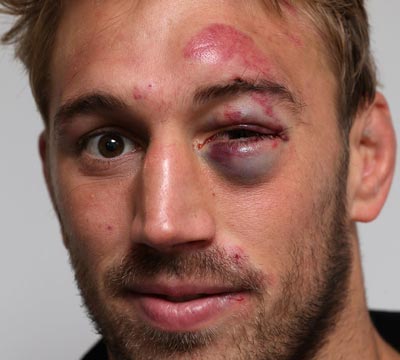 chris robshaw smashed face black eye